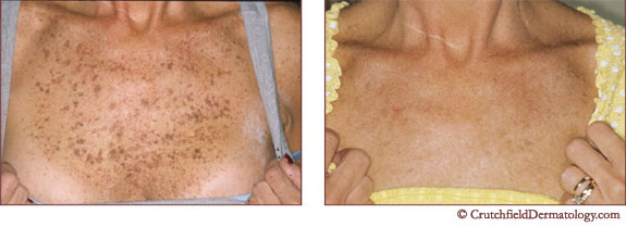 Get Rid of Freckles, Actinic Lentigo Treatment