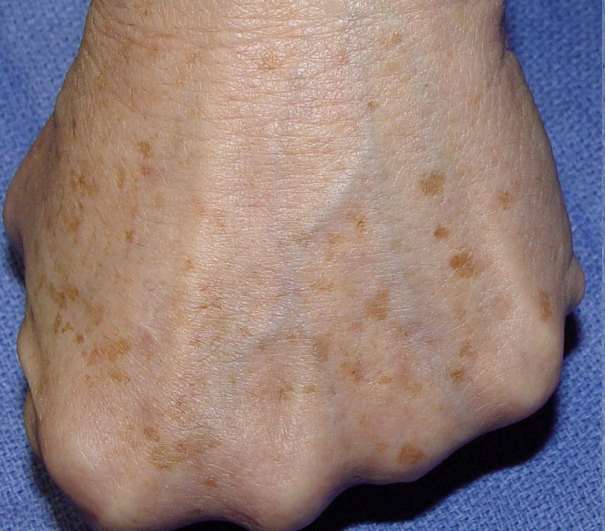 Hyperpigmentation Treatments Back of hand showing age spots