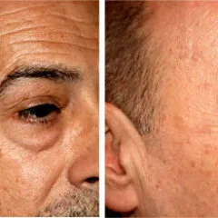 age-spot4