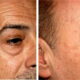 age-spot4