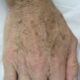 age-spots