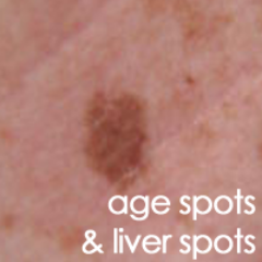 age-spots-and-liver-spots