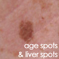 Age Spots and Liver Spots | Ag3derm