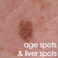 Age Spots and Liver Spots | Ag3derm