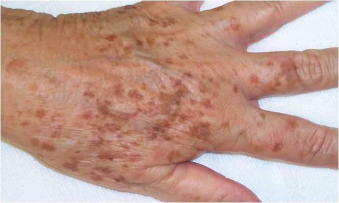 age-spots-on-hands