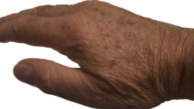 Image shows a close up of age spots on a hand.