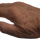 Image shows a close up of age spots on a hand.