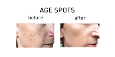 age_spots2