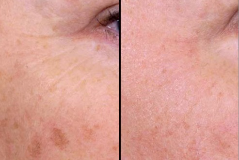 Before and After Images - Physicians Tattoo &amp; Age Spot Removal in ...