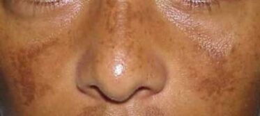 top-treatment-for-age-spots-belo-or-calayan-1