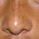 top-treatment-for-age-spots-belo-or-calayan-1