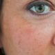 webmd_rf_photo_of_age_spots_on_face