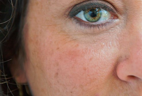 Antiaging Slideshow: Get Rid of Wrinkles, Dark Circles, and More