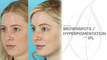 ipl for age spot removal No. 2