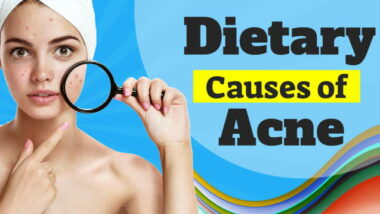Dietary causes of acne featured image.