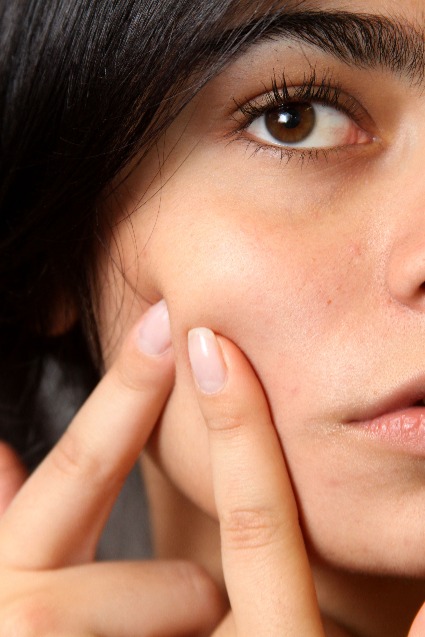 Using Colloidal Silver Face Cream for acne treatment.