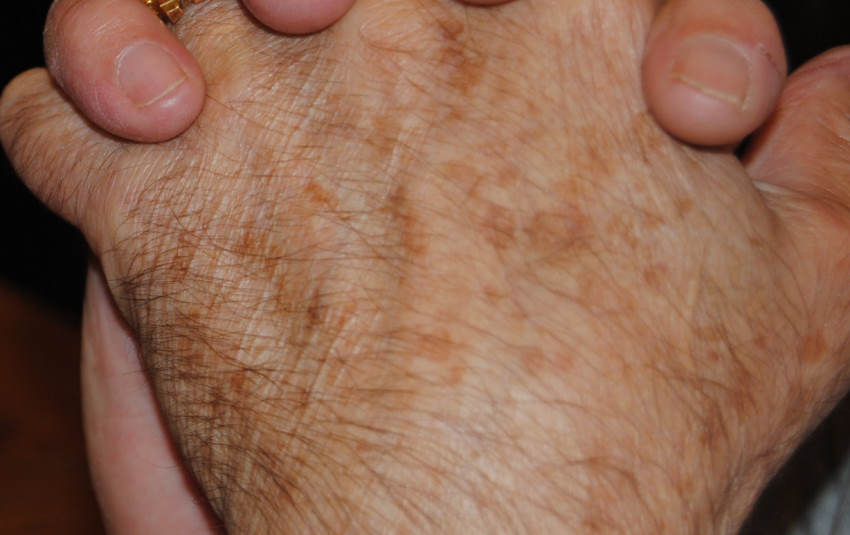 Age spots on the back of a hand