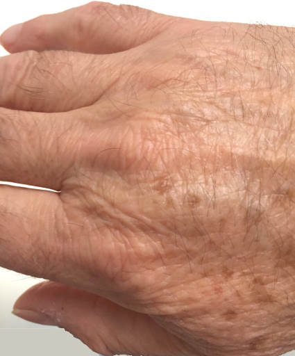 Age spots on the back of hand.