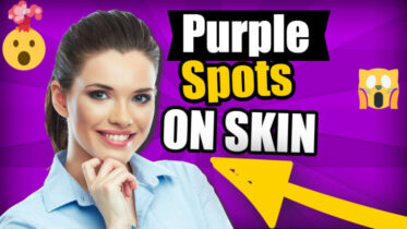 Image text: "purple spots on skin featured image".