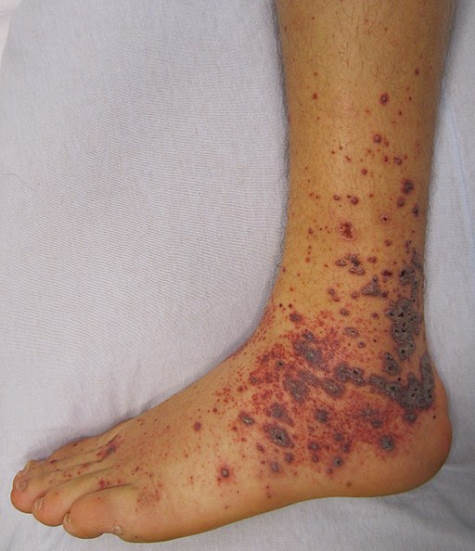 Purpura - Purple spots on skin.
