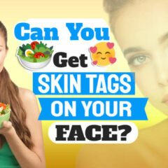 Featured image text: "Can you get skintags on face".