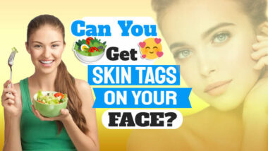 Featured image text: "Can you get skintags on face".