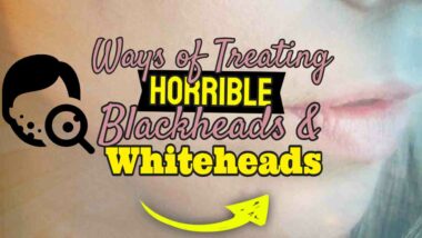 Image text: "Ways of treating horrible blackheads and whiteheads".