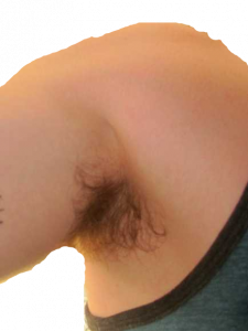 Image shows an armpit with early darker discoloration