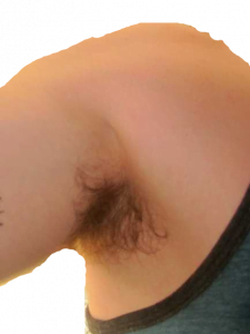 Image shows an armpit with early darker discoloration