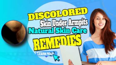 Featured image with text: "Discolored skin under armpits".