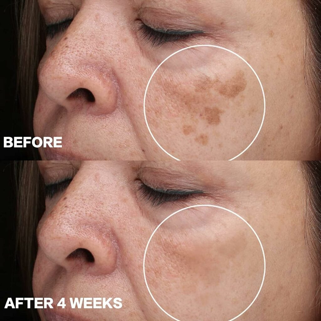 CITYGOO Dark Spot Remover for Face and Body, Dark Spot Corrector Cream, Melasma Treatment, Hyperpigmentation Treatment, Freckle Remover With Tranexamic acid, Niacinamide, Squalane and Vitamin E Serum-1.7 FL OZ